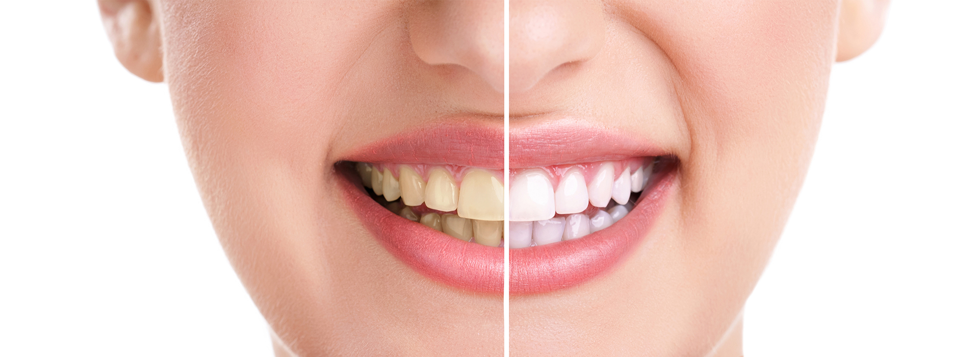 HP Dental | TMJ Disorders, Botox reg and Ceramic Crowns